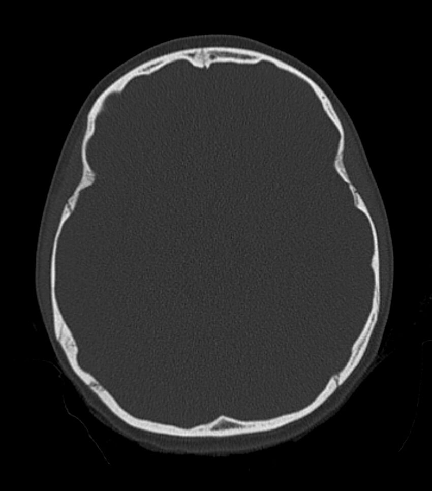 Nasoorbitoethmoid fracture (Radiopaedia 90044-107205 Axial bone window 98).jpg