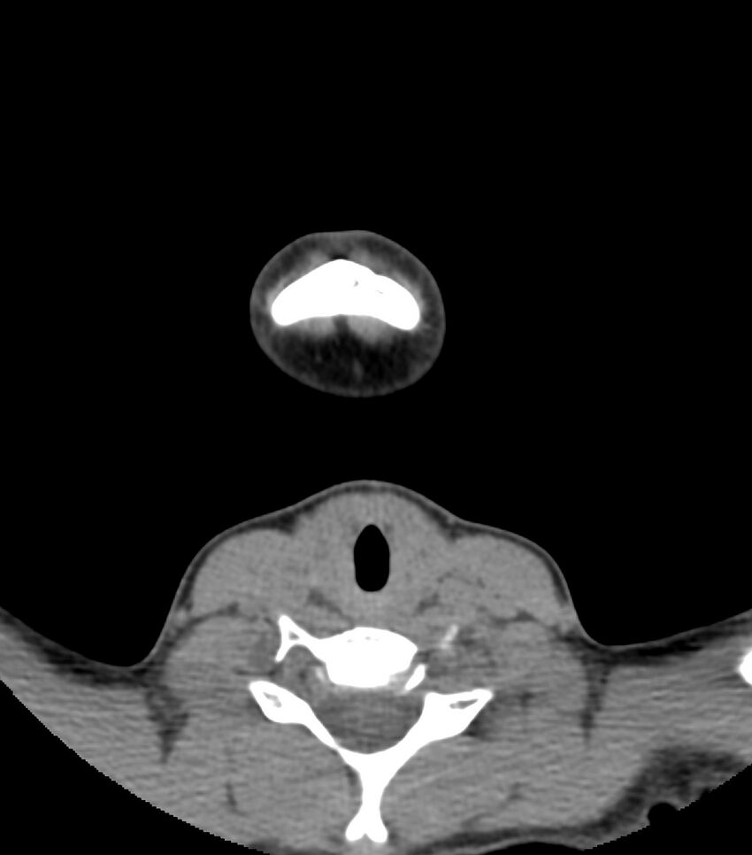 Nasoorbitoethmoid fracture (Radiopaedia 90044-107205 Axial non-contrast 16).jpg