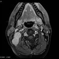 Nasopharyngeal carcinoma (Radiopaedia 4546-6667 Axial T1 C+ fat sat 18).jpg