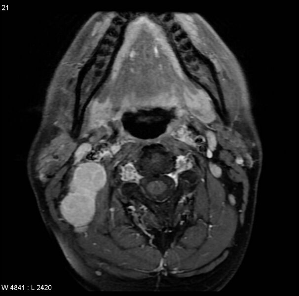 File:Nasopharyngeal carcinoma (Radiopaedia 4546-6667 Axial T1 C+ fat sat 18).jpg