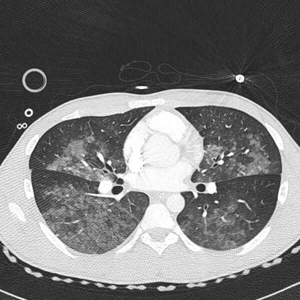 File:Near drowning (pulmonary edema) (Radiopaedia 24685-24958 lung window 32).jpg