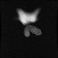 Necrotizing epididymo-orchitis with intra-testicular abscess (Radiopaedia 29397-29860 Coronal T1 3).jpg
