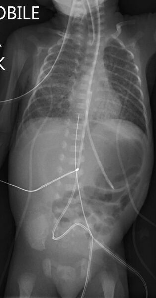 File:Neonatal bowel perforation (Radiopaedia 23839-23993 Frontal 1).jpg