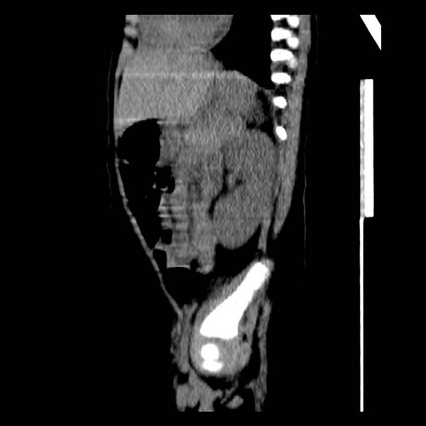 File:Neuroblastoma with skull metastases (Radiopaedia 30326-30960 B 30).jpg