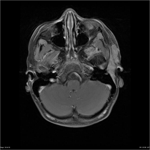 File:Neurofibromatosis type 1 (Radiopaedia 22541-22564 Axial T1 C+ fat sat 19).jpg