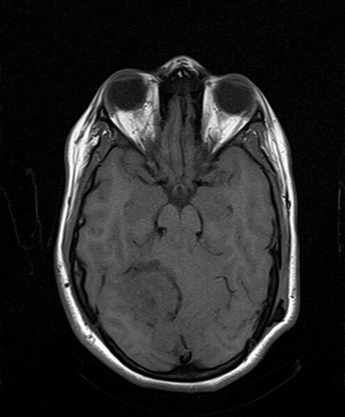 File:Neurofibromatosis type 2 (Radiopaedia 66211-75401 Axial T1 13).jpg
