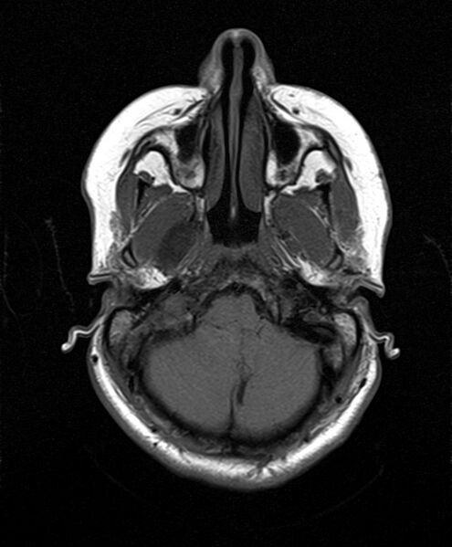 File:Neurofibromatosis type 2 (Radiopaedia 66211-75401 Axial T1 8).jpg