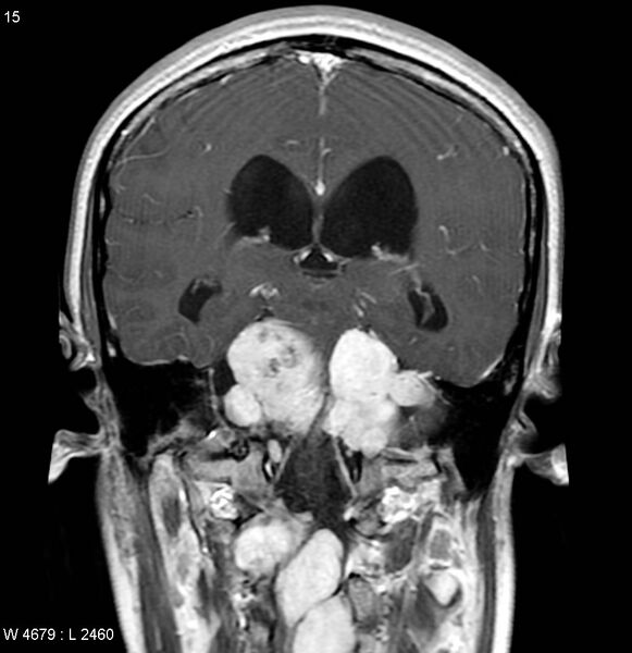 File:Neurofibromatosis type 2 - cranial and spinal involvement (Radiopaedia 5351-7111 Coronal T1 C+ 8).jpg