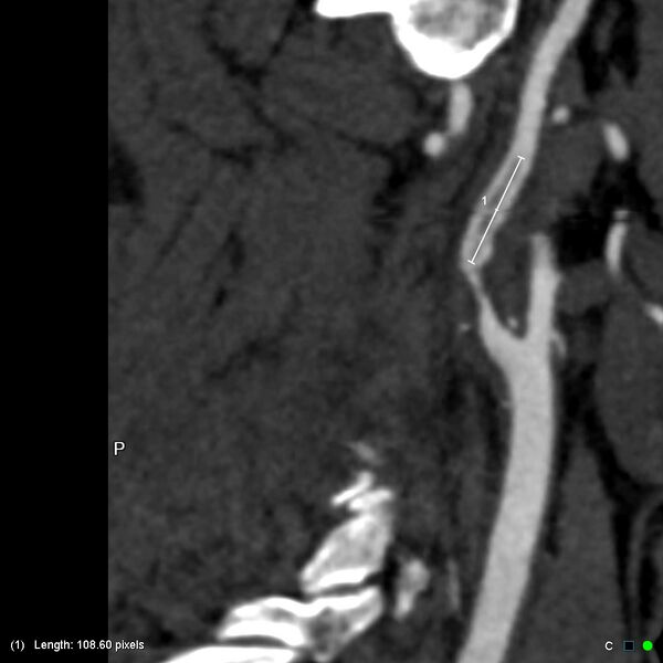 File:Non-occlusive intraluminal internal carotid artery thrombus (Radiopaedia 37751-39658 A 21).jpg