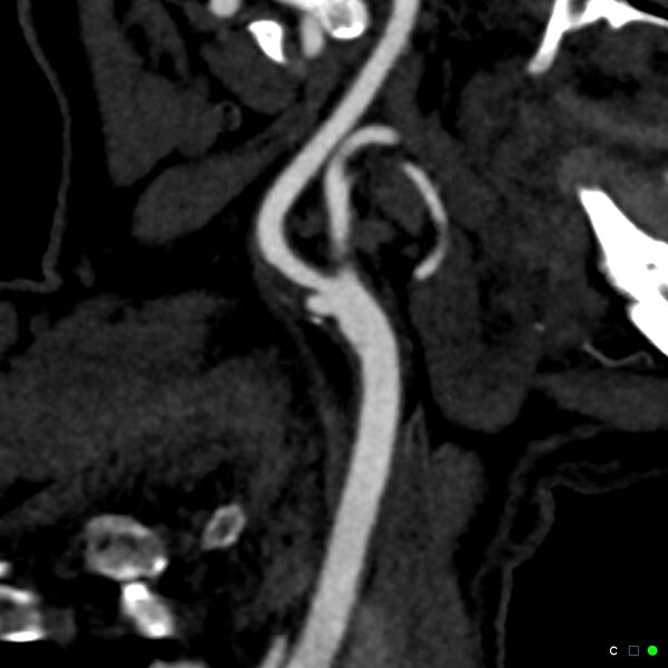 File:Non-occlusive intraluminal internal carotid artery thrombus (Radiopaedia 37751-39658 C 21).jpg