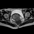 Non-puerperal uterine inversion (Radiopaedia 78343-90983 Axial T2 14).jpg