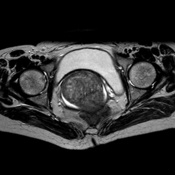 File:Non-puerperal uterine inversion (Radiopaedia 78343-90983 Axial T2 14).jpg