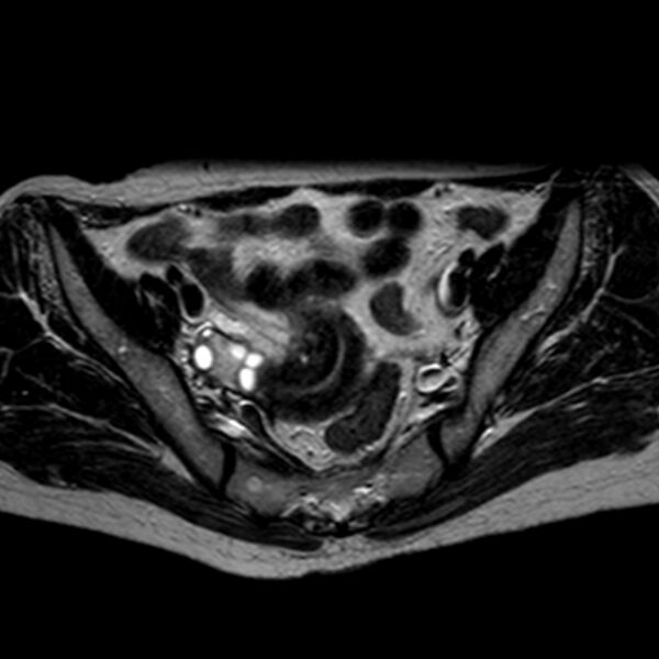 File:Non-puerperal uterine inversion (Radiopaedia 78343-90983 Axial T2 25).jpg