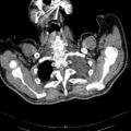 Non Hodgkin lymphoma in a patient with ankylosing spondylitis (Radiopaedia 84323-99621 Axial non-contrast 1).jpg