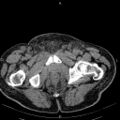 Non Hodgkin lymphoma in a patient with ankylosing spondylitis (Radiopaedia 84323-99621 Axial non-contrast 63).jpg