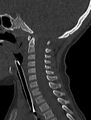 Normal CT cervical spine - pediatric (Radiopaedia 52549-58462 Sagittal bone window 100).jpg
