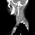 Normal CT of the neck (Radiopaedia 14575-14500 Sagittal C+ 15).jpg