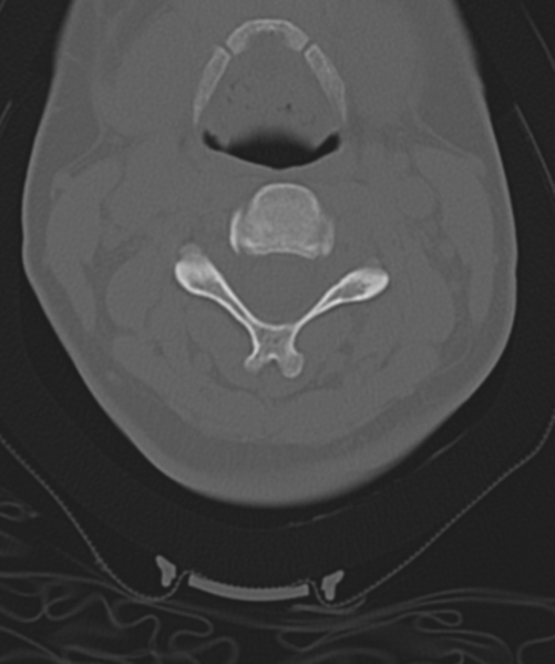 File:Normal cervical spine MRI (including Dixon) (Radiopaedia 42762-45926 Axial bone window 25).png