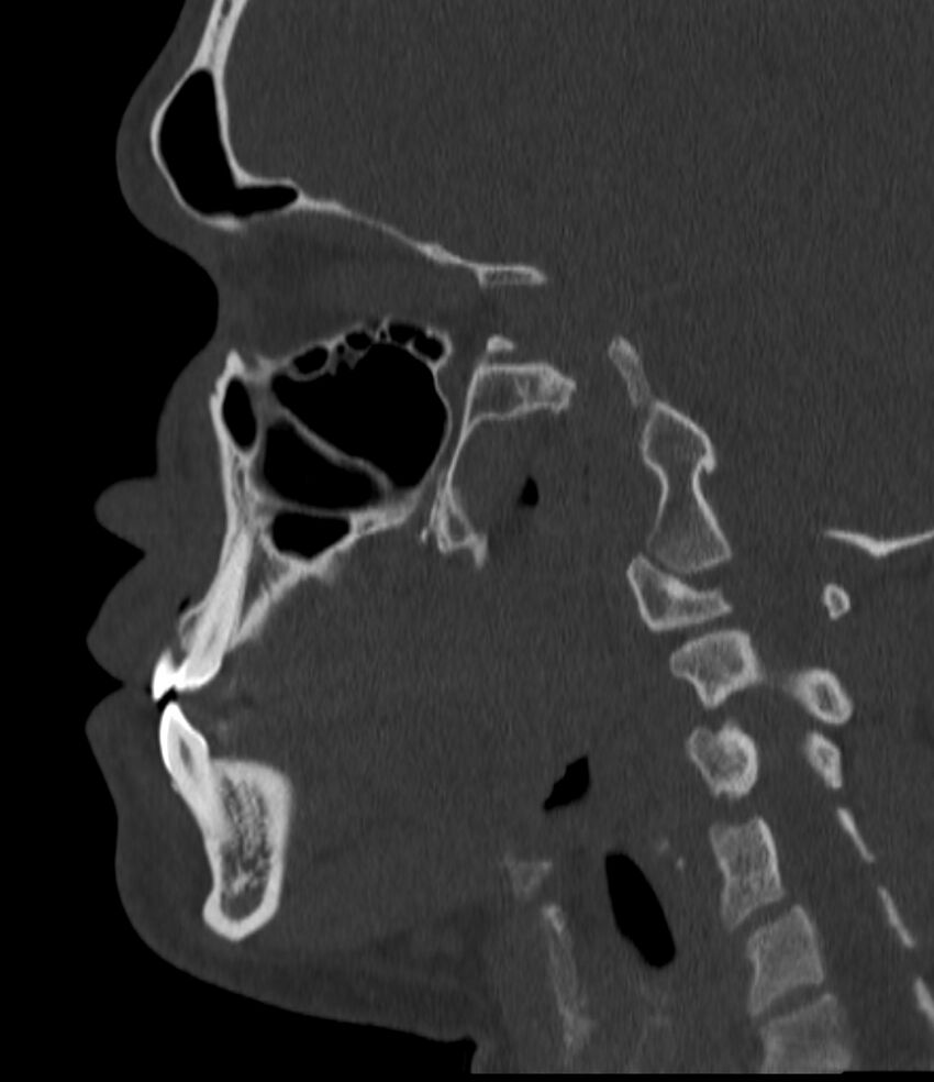 Normal facial bone CT (Radiopaedia 88742-105476 Sagittal bone window 101).jpg