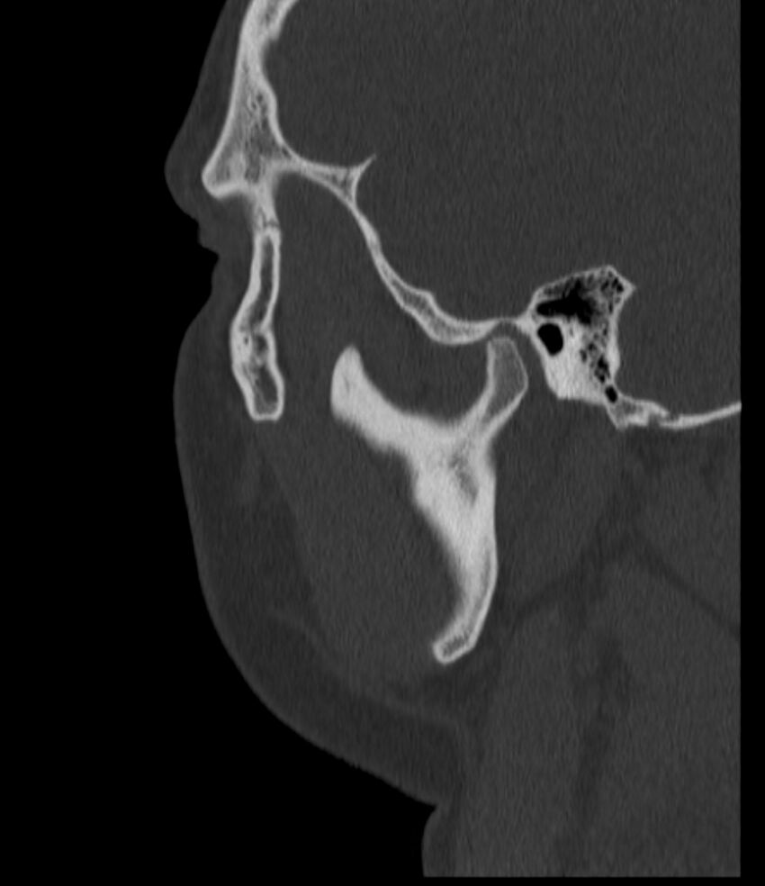 Normal facial bone CT (Radiopaedia 88742-105476 Sagittal bone window 134).jpg