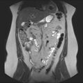 Normal liver MRI with Gadolinium (Radiopaedia 58913-66163 Coronal T2 16).jpg