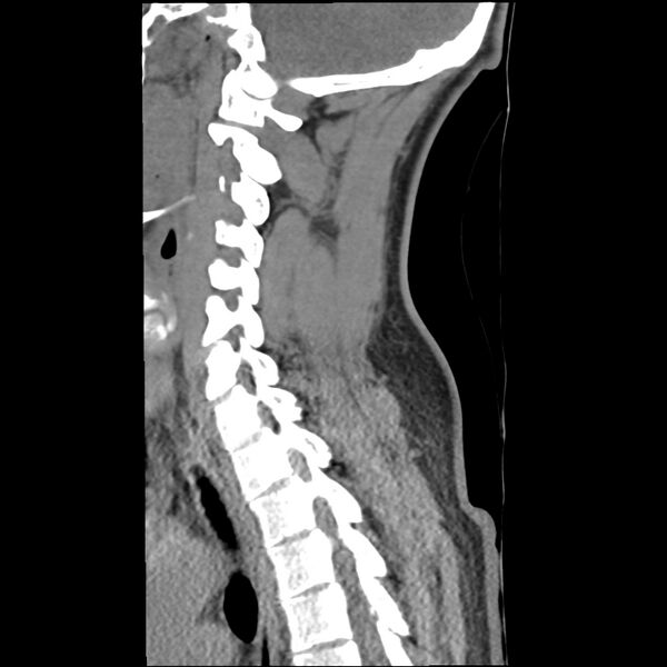 File:Normal trauma spine imaging (Radiopaedia 31753-32686 A 27).jpg