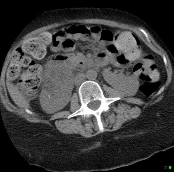 File:Obstructed infected horseshoe kidney (Radiopaedia 18116-17898 non-contrast 12).jpg