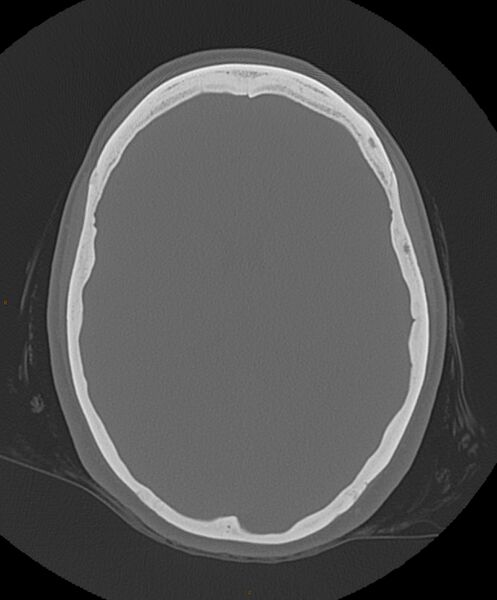 File:Occipital condyle fracture (Radiopaedia 61165-69056 Axial bone window 10).jpg