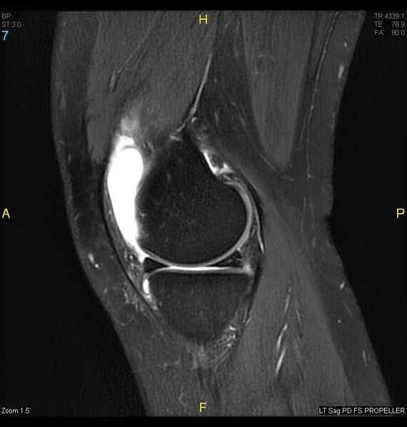 File:ACL mucoid degeration with cystic changes (Radiopaedia 48428-53341 Sagittal PD fat sat 5).jpg