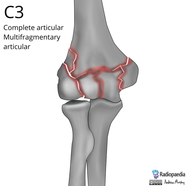 File:AO-OTA classification of distal humeral fractures (Radiopaedia 85949).png