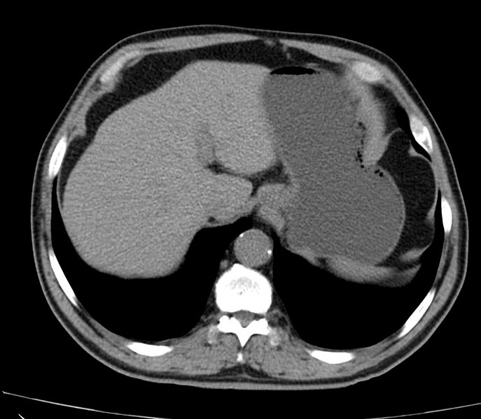 File:Abdominal aortic aneurysm (Radiopaedia 22421-22458 non-contrast 8).jpg