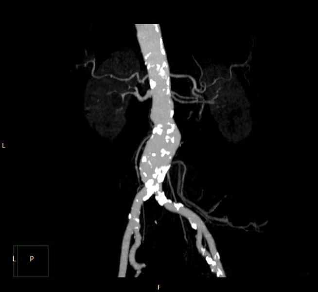 File:Abdominal aortic aneurysm (Radiopaedia 23703-23856 MIP 14).jpg
