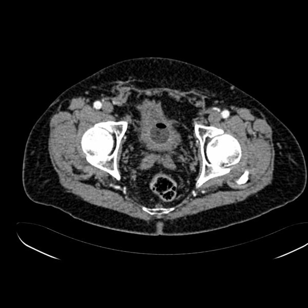 File:Abdominal aortic aneurysm (Radiopaedia 75131-86203 Axial C+ arterial phase 44).jpg
