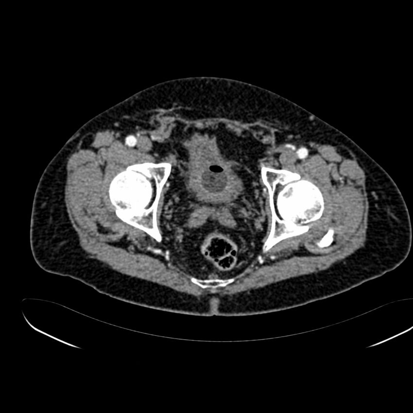 Abdominal aortic aneurysm (Radiopaedia 75131-86203 Axial C+ arterial phase 44).jpg