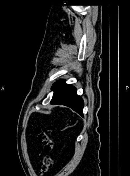 File:Abdominal aortic aneurysm (Radiopaedia 83094-97462 Sagittal renal cortical phase 115).jpg