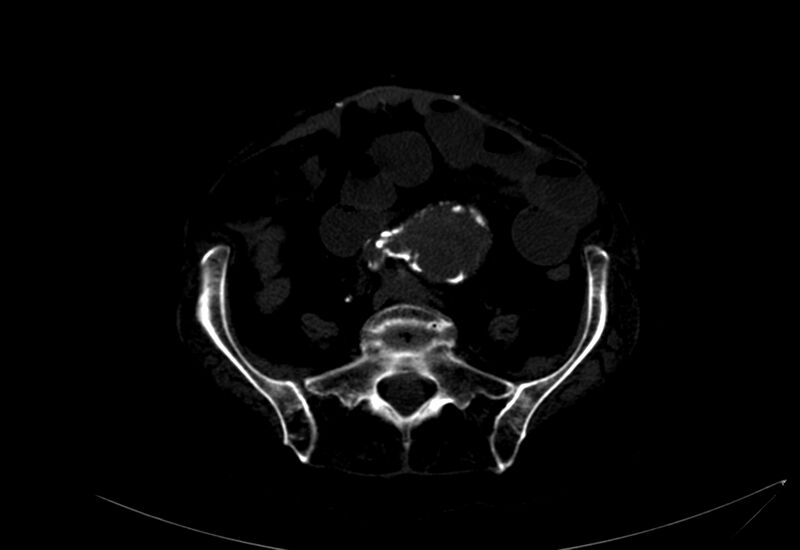 File:Abdominal aortic aneurysm - impending rupture (Radiopaedia 19233-19246 B 37).jpg