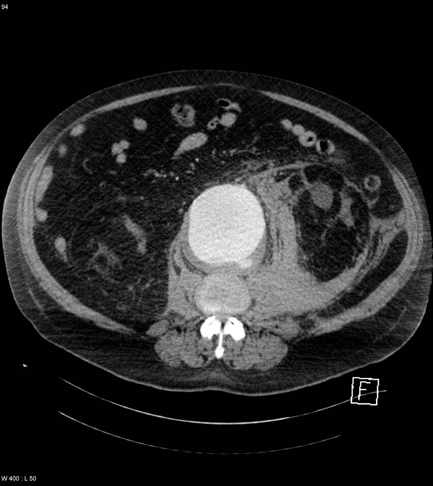 Abdominal aortic aneurysm with intramural hematoma then rupture (Radiopaedia 50278-55632 Axial C+ arterial phase 93).jpg