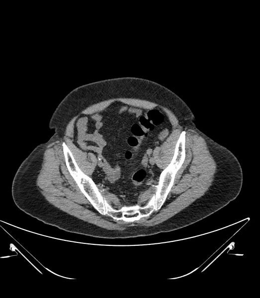 File:Abdominal aortic aneurysm with thrombus fissuration (Radiopaedia 46218-50618 Axial non-contrast 47).jpg