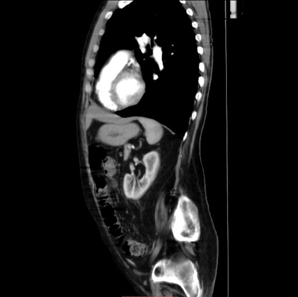 File:Abdominal aortic interposition tube graft and aneurysm thrombosis (Radiopaedia 71438-81857 Sagittal C+ arterial phase 9).jpg