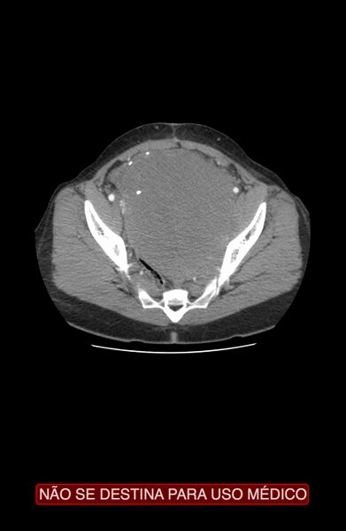 File:Abdominal desmoid tumor (Radiopaedia 44024-47540 Axial C+ arterial phase 40).jpg