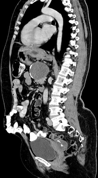 File:Abdominal hydatid disease (Radiopaedia 68223-77737 Sagittal C+ portal venous phase 31).jpg