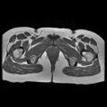 Abdominal wall endometriosis (Radiopaedia 83702-98847 Axial T1 19).jpg