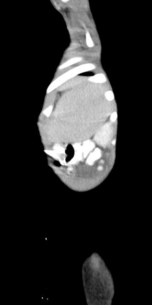 File:Abdominopelvic rhabdomyosarcoma (Radiopaedia 78356-90984 Sagittal C+ portal venous phase 11).jpg