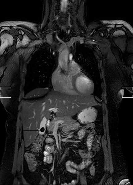 File:Aberrant right subclavian artery with background Takayasu arteritis (Radiopaedia 21423-21363 Coronal MRA 4).jpg