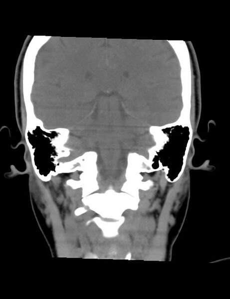 File:Accessory parotid glands (Radiopaedia 27289-27472 Coronal non-contrast 2).jpg