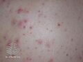 Acne affecting the back images (DermNet NZ acne-acne-back-175).jpg