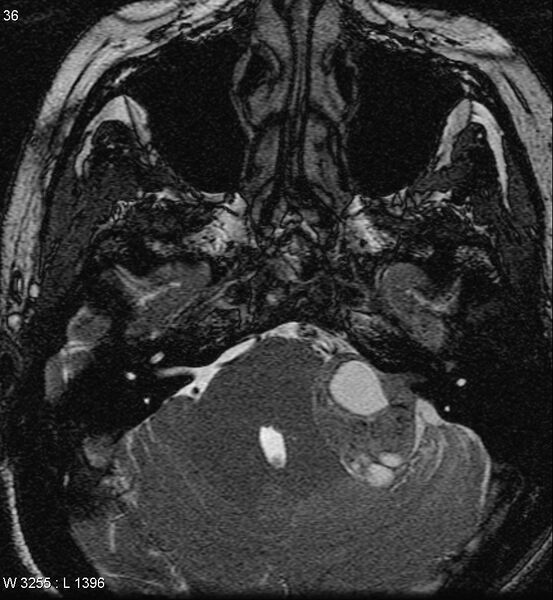 File:Acoustic schwannoma (large with cystic change) (Radiopaedia 5369-7130 Axial T2 5).jpg