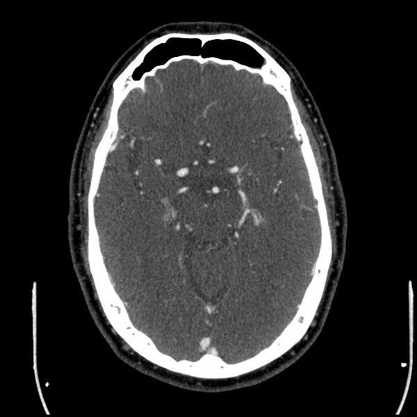 File:Acute A3 occlusion with ACA ischemic penumbra (CT perfusion) (Radiopaedia 72036-82527 Axial C+ arterial phase thins 95).jpg
