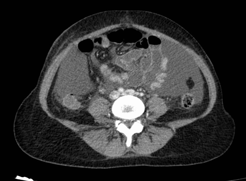 File:Acute Budd-Chiari syndrome (Radiopaedia 60858-68638 Axial C+ portal venous phase 195).jpg