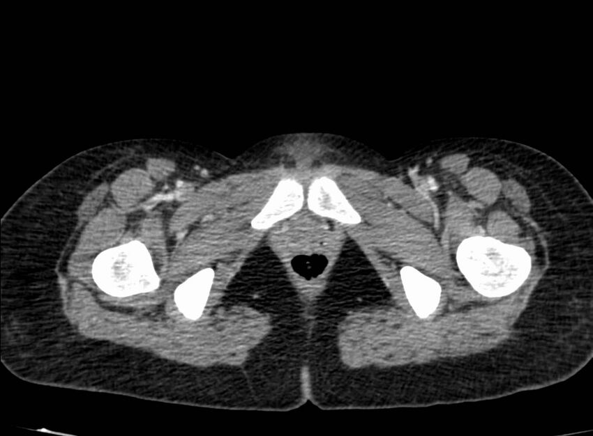 Acute Budd-Chiari syndrome (Radiopaedia 60858-68638 Axial C+ portal venous phase 309).jpg